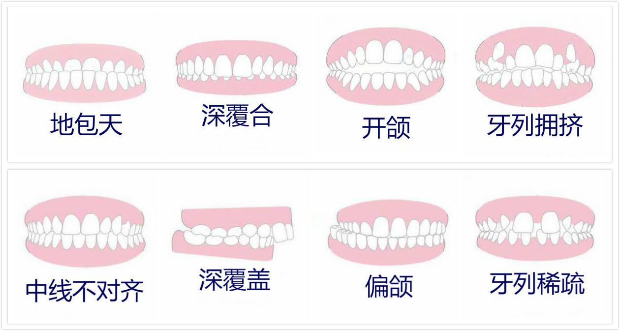 很多家长以为矫正要等到换完牙,其实有些错颌畸形,在乳牙期,替牙期